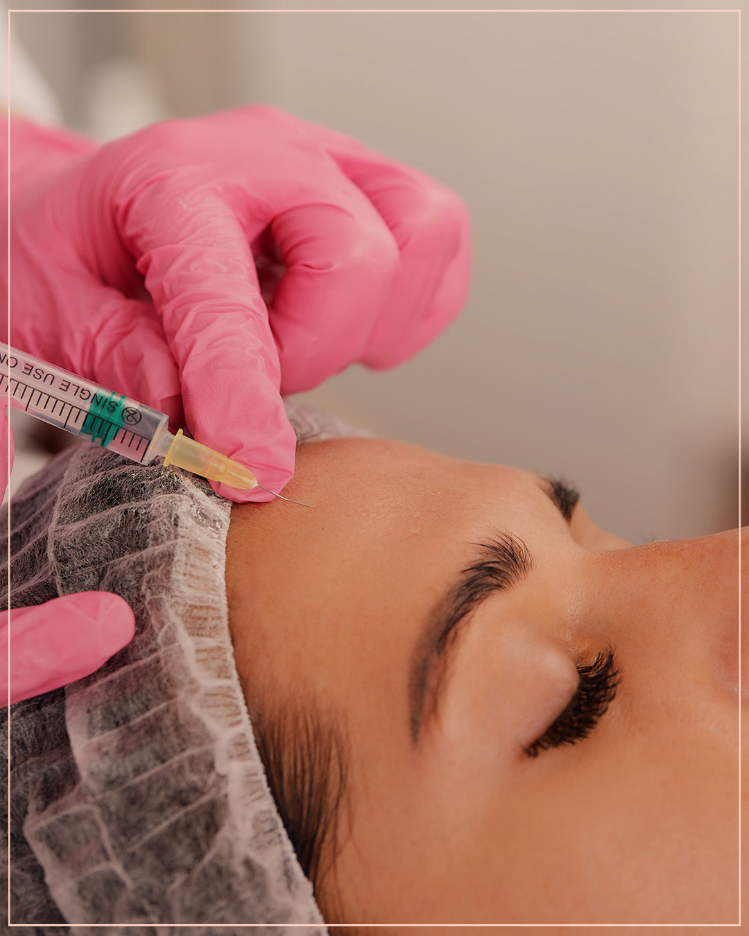 Botox for Migraine Treatment
