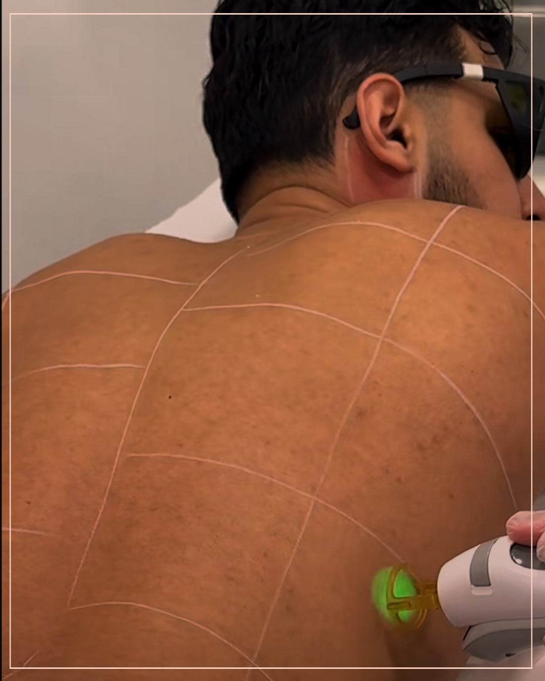 3 Full body laser session for men