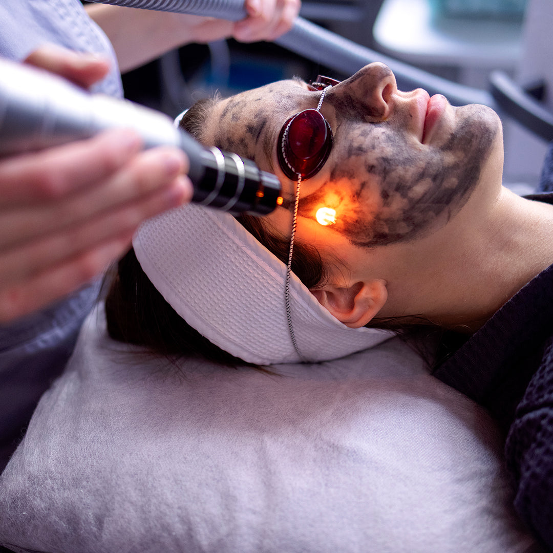 جلسة ليزر كربوني للوجه