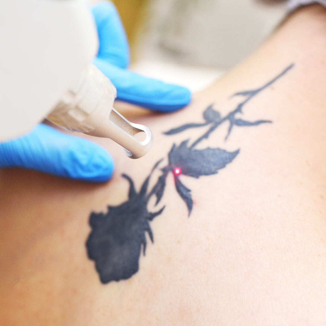 ازالة التاتو تبدأ من