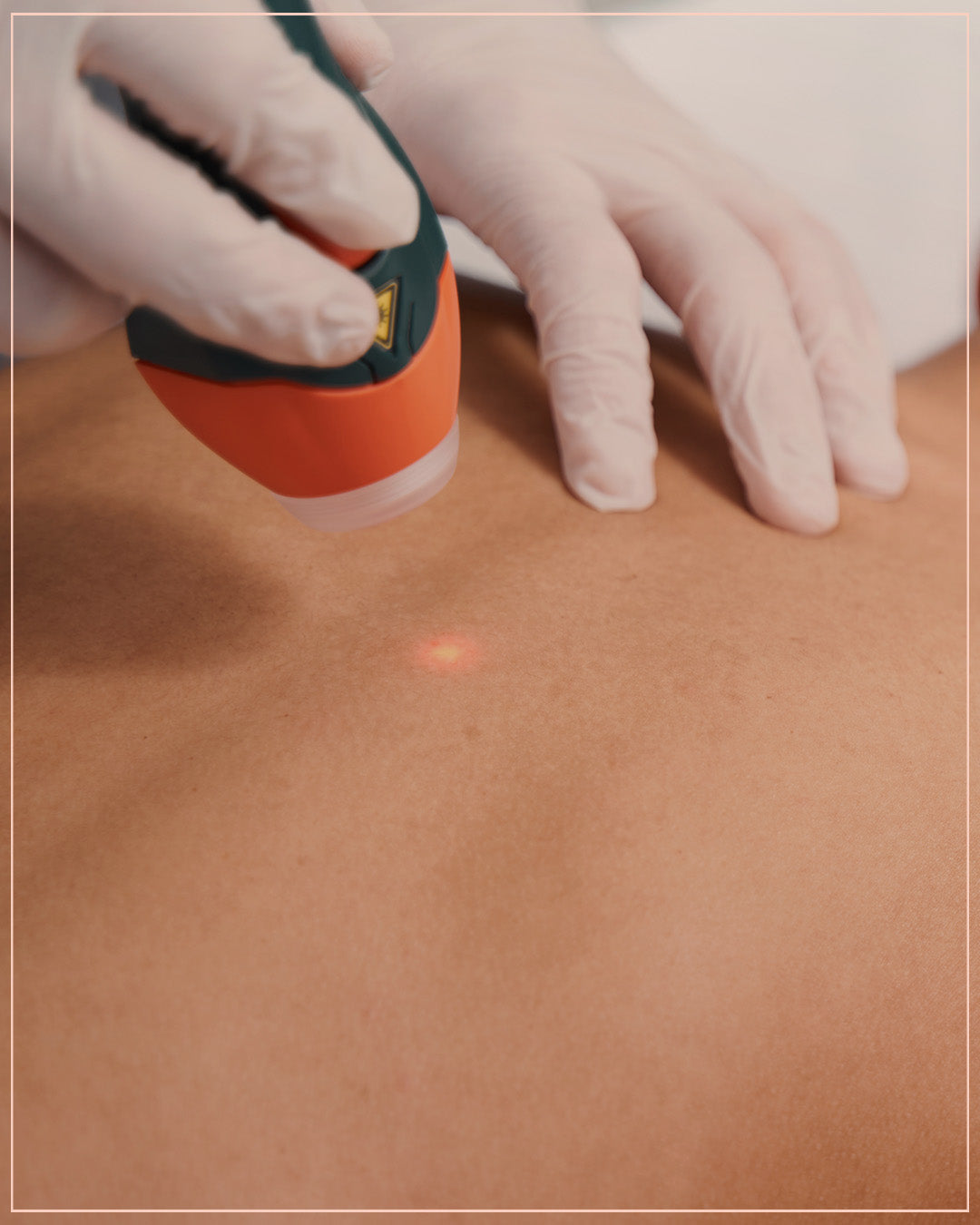3 Full body laser session for men