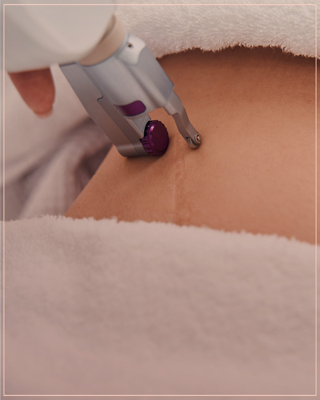 Fractional laser for Belly