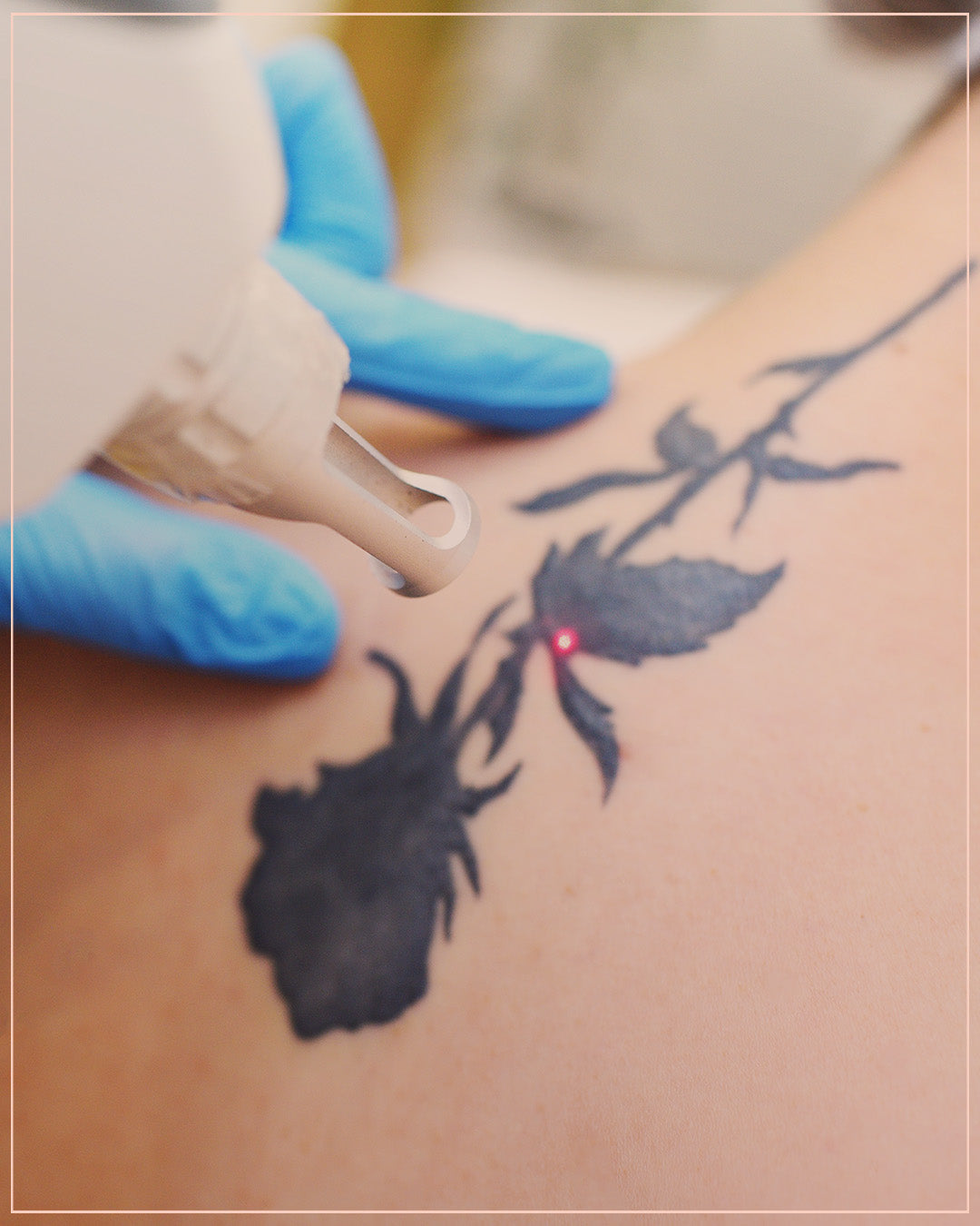 Tattoo Removing