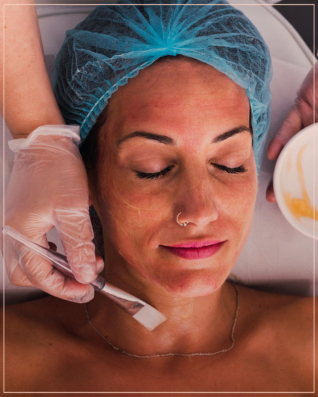 Cold peeling with cream (Cimel)