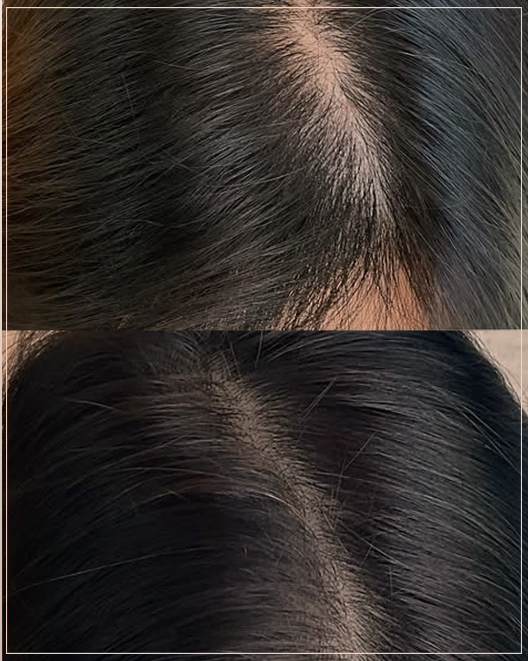 باقة الزراعة الملكية (زراعة الشعر + المتابعة + 3 بلازما + 2 ميزو + شامبو + بلسم)