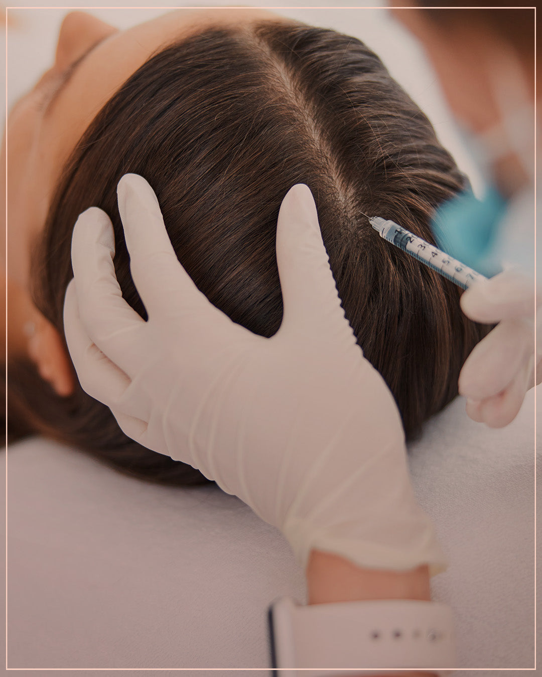 Regenera Session for Hair Loss Treatment