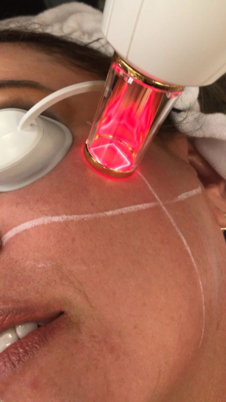 جلسة ليزر لمنطقتين صغيرة (وجه و أبطين) للنساء أو الرجال بدون رتوش