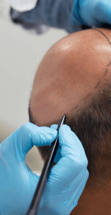 Basic Hair Transplant Package (consultation + follow-up + shampoo and conditioner + headscarf + 2 plasma sessions)