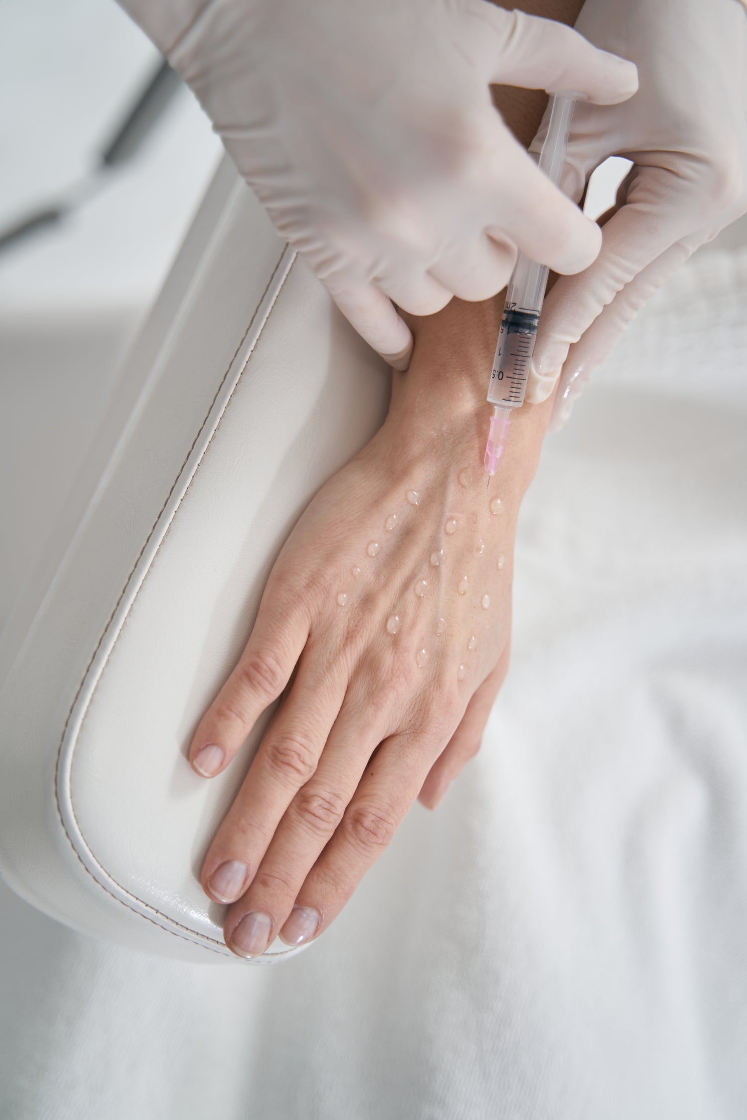 Radiesse Injections for Hands